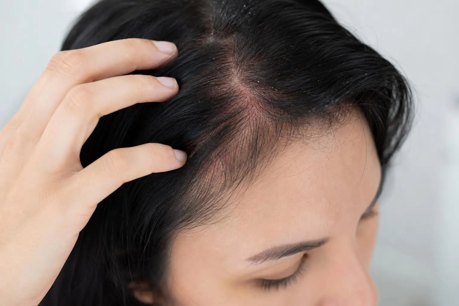 Cuir chevelu qui gratte et perte de cheveux : causes et solutions